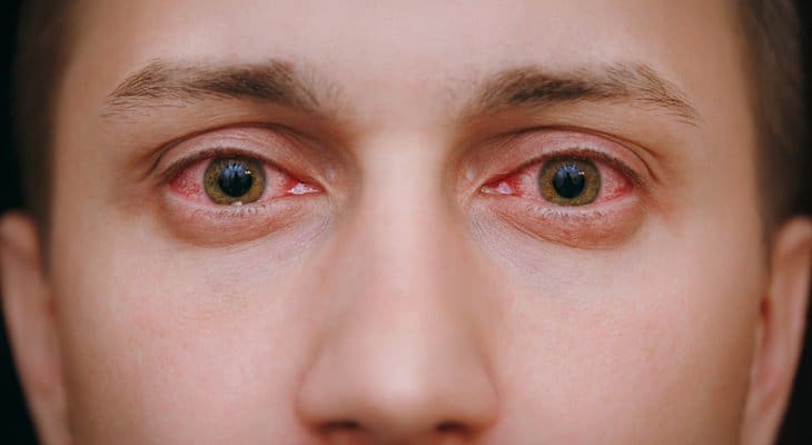 Conjunctivitis