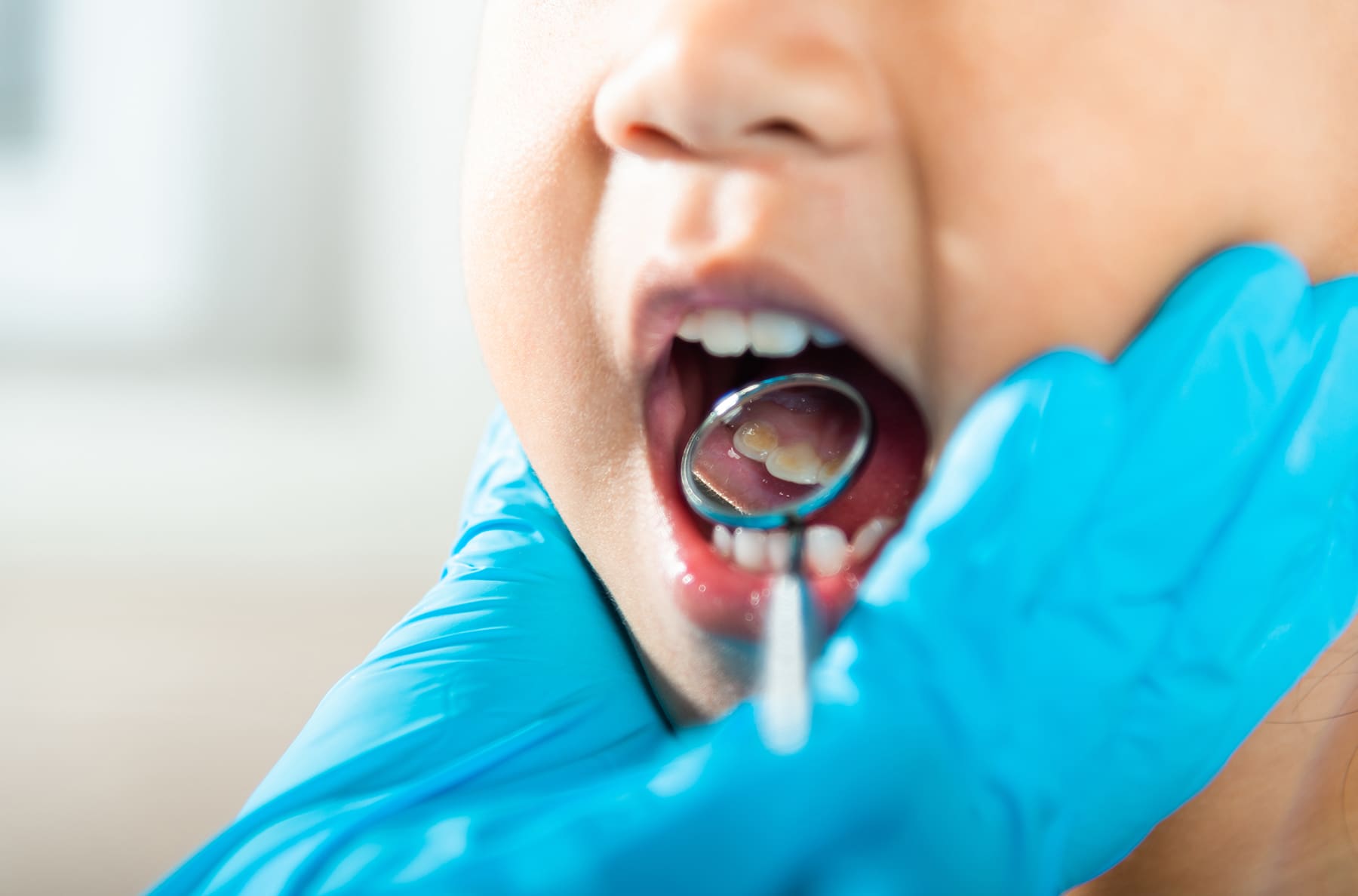 What Happens If a Child Has a Cavity? Here’s What To Expect