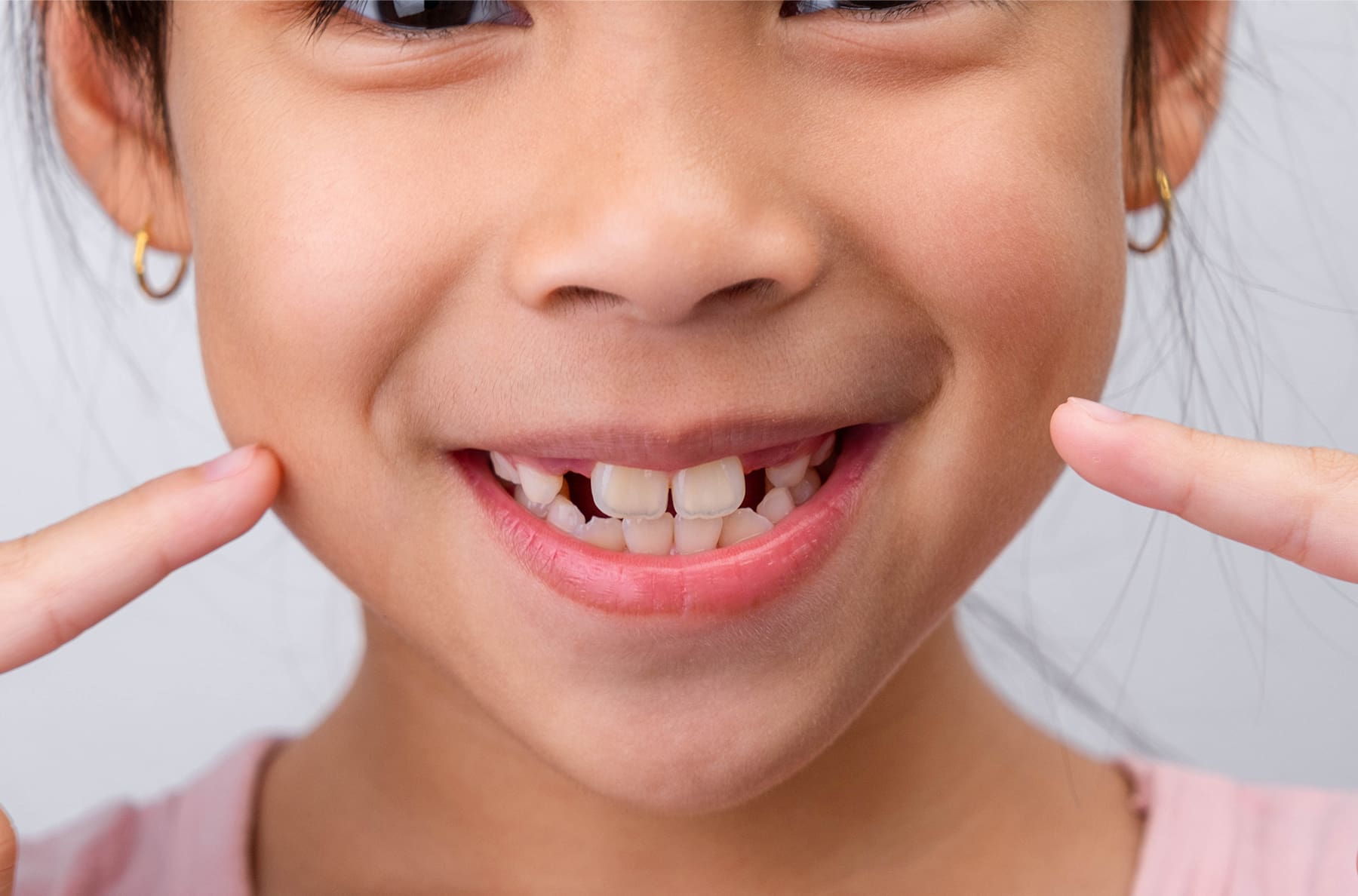Why More Kids Have Crooked Teeth (It’s Not Just Genetics)