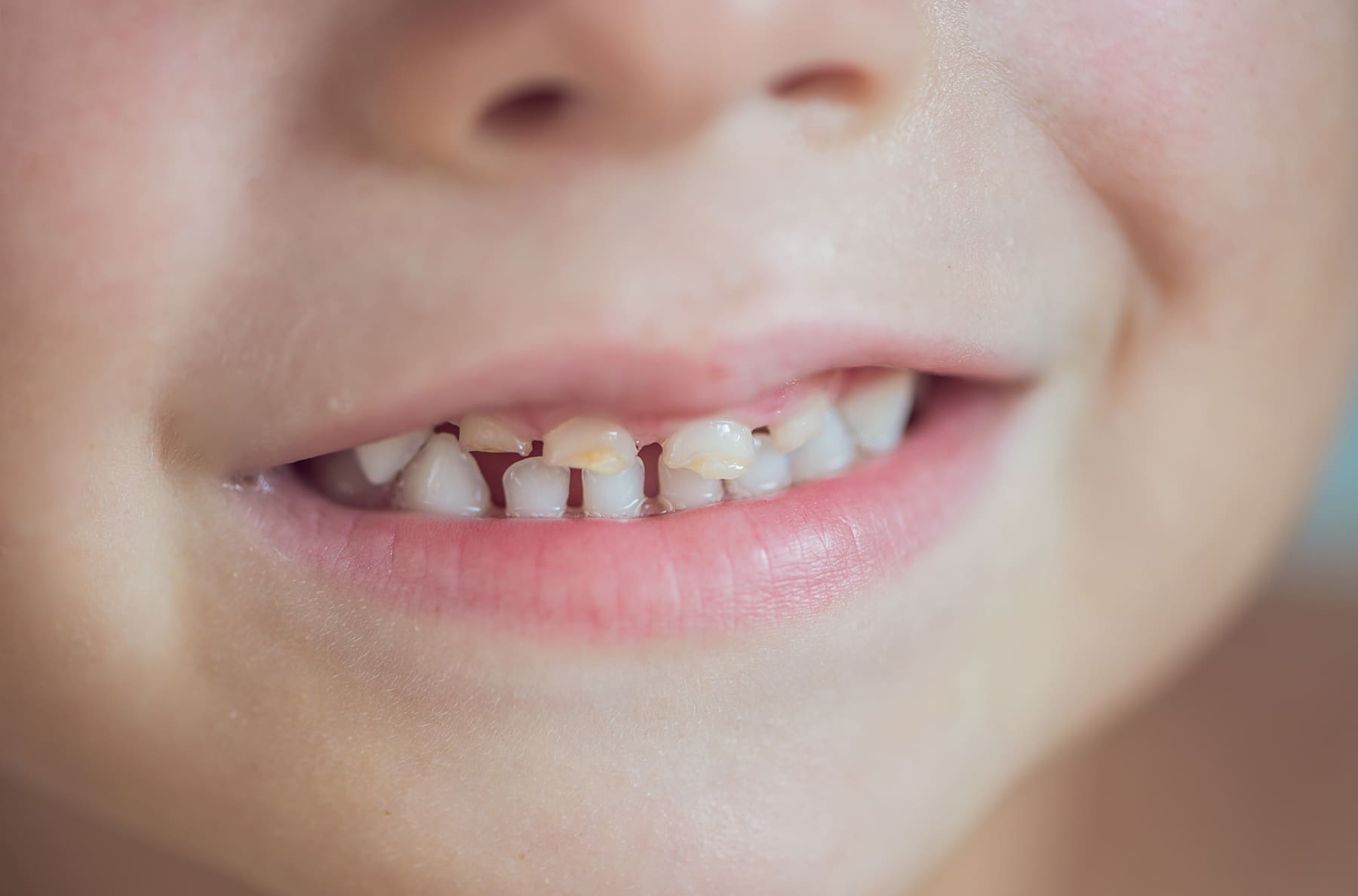 Why Does My Child Have Brown Teeth?