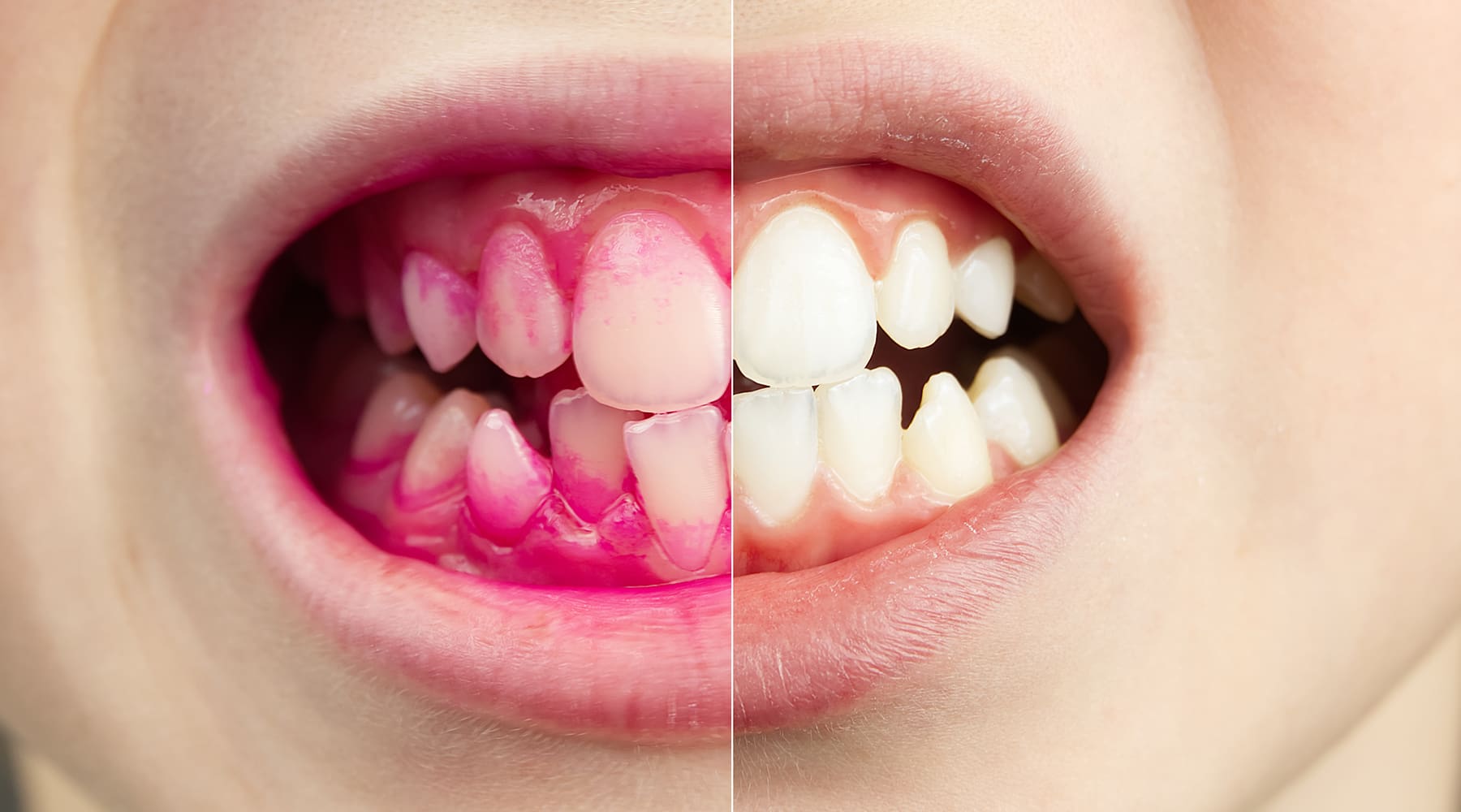 Plaque Disclosing Tablets for Kids: How They Work and How to Use Them
